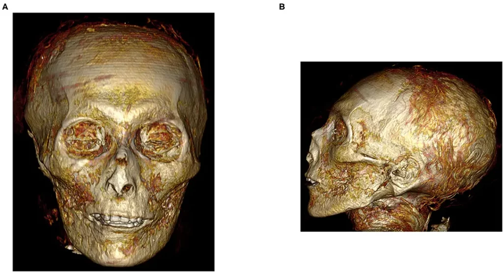 Three-dimensional CT image of the digitally